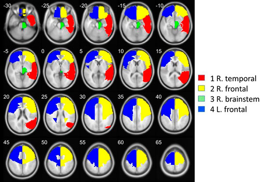 Un estudio muestra los posibles beneficios para el cerebro de la meditación basada en el silencio mental